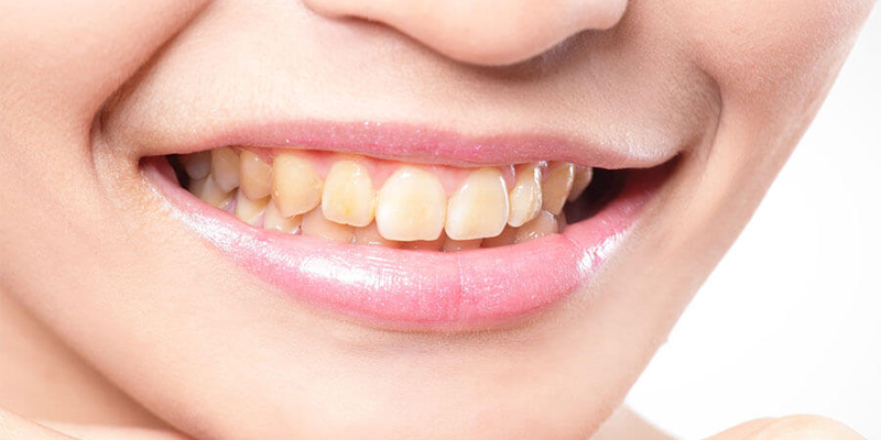 Dişlerde Neden Lekenme ve Renk Değişimi Olur?